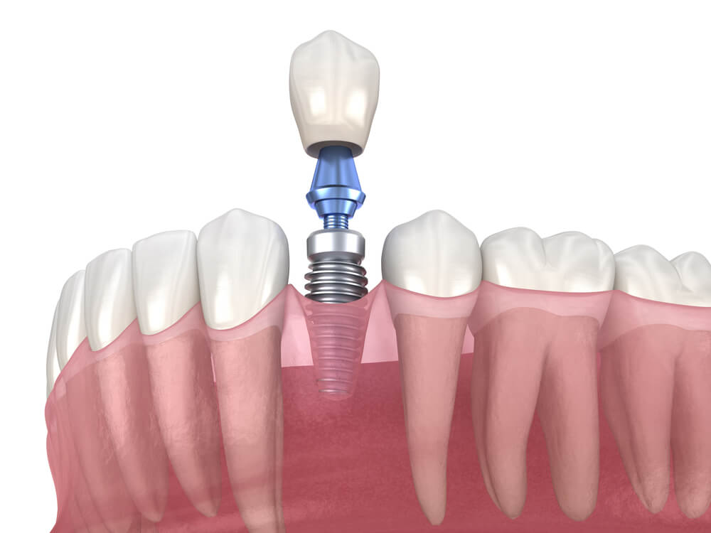 dental implant