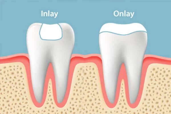 Removable denture