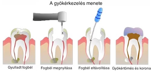 Removable denture