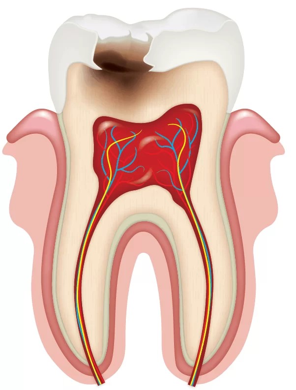 The tooth in the section